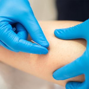 Healthcare professional in blue gloves pricking the skin with a lancet for a blood test on a forearm